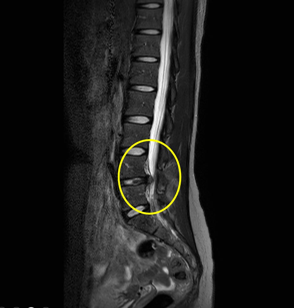 椎間盤突出使大小腿痠麻 選擇脊椎微創內視鏡治療快速又安全